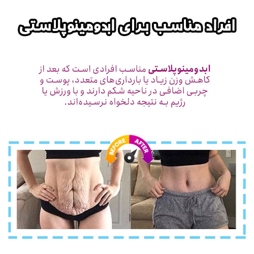 ابدومینوپلاستی 