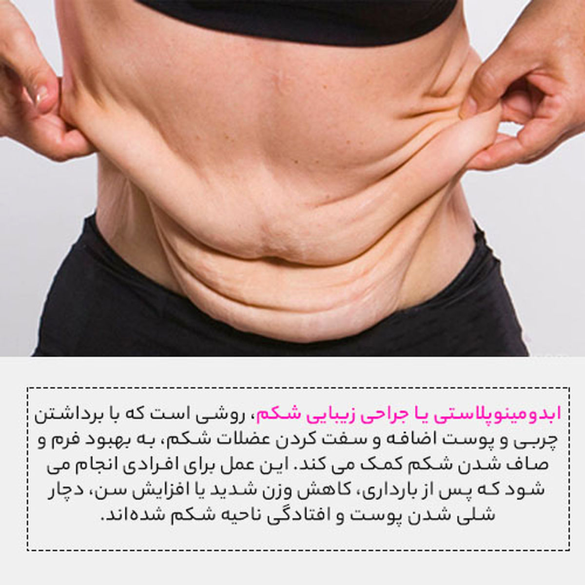 ابدومینوپلاستی برای چه افرادی مناسب است؟